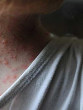 اصابات بالجدري