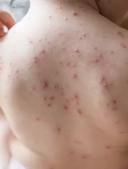 الجدري والاطفال