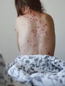 جدري القرود