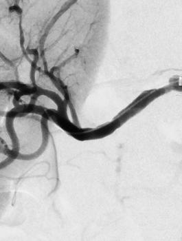 ازالة كلية سليمة بدل تالفة في الاردن