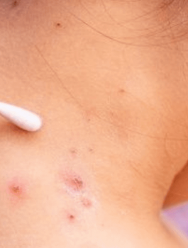 اسرائيل والاصابات بجدري القرود