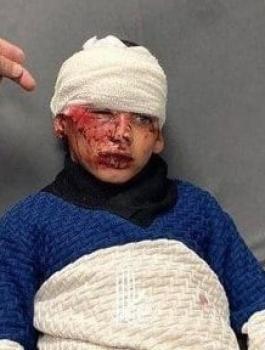 اصابة طفل بهجوم للمستوطنين