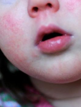 وفاة اطفال بسبب البكتيريا