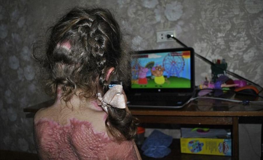 طفلة تصاب بحروق بليغة بسبب لعبة