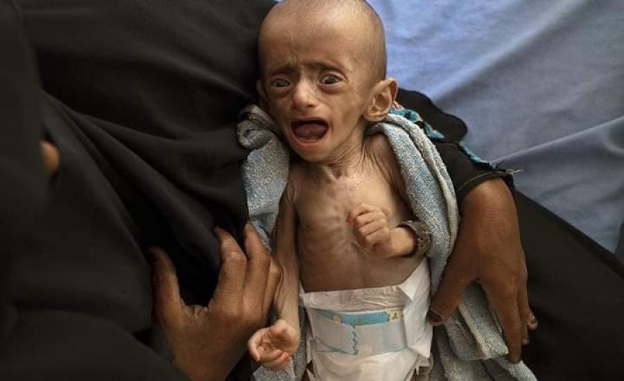 وفاة اطفال اليمن 