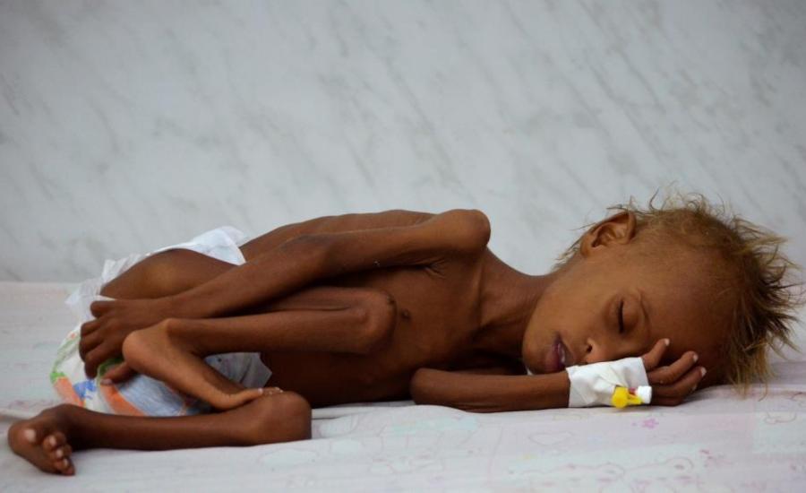الجوع الشديد في اليمن 