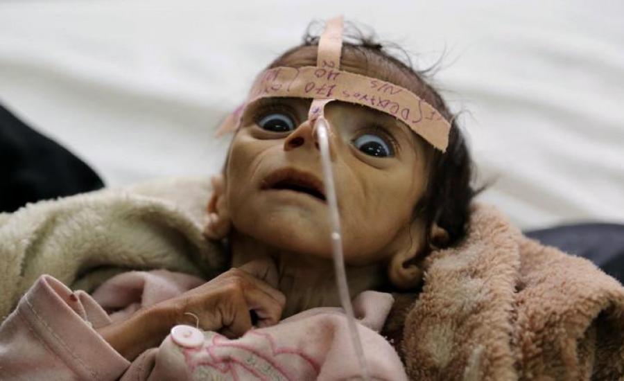 موت اطفال اليمن 