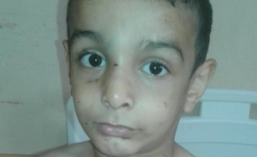 طفل يتعرض للضرب والحرق على يد جدته في غزة 
