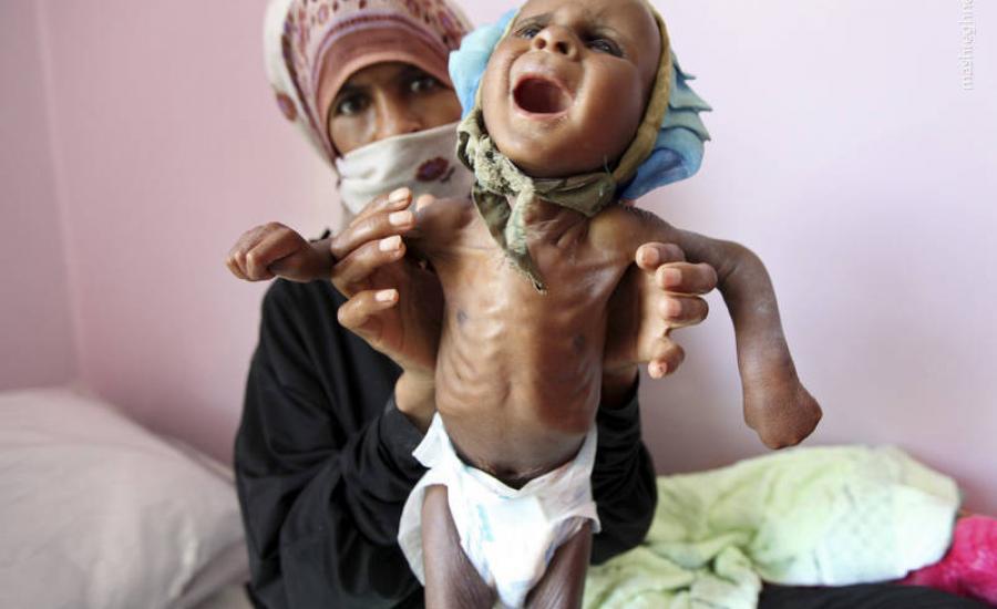 الكوليرا في اليمن 