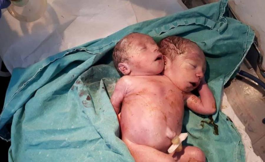 ولادة طفل سوري برأسين 