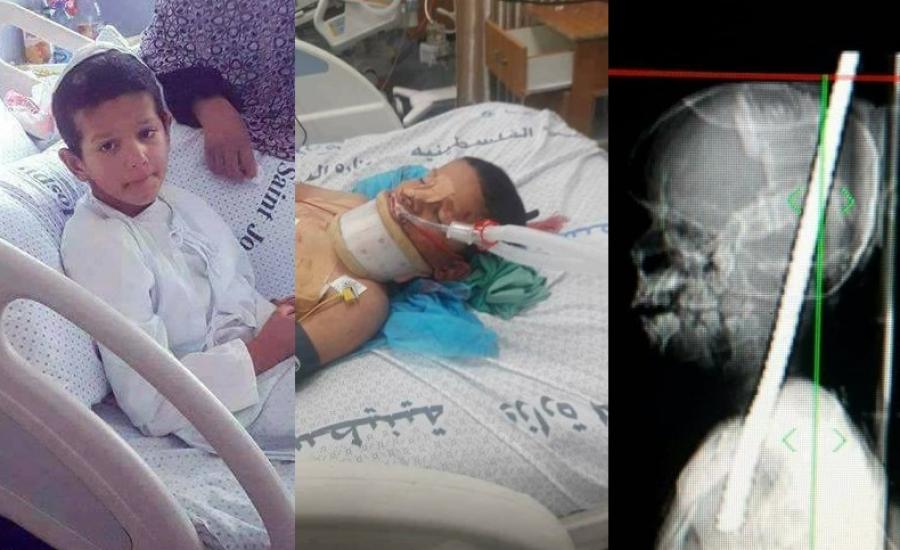 تفاصيل قصة الطفل الذي اخترق قضيب حديد رأسه دون أن يقتله في غزة-275x500