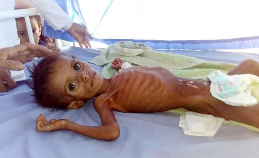 موت اطفال اليمن بسبب الجوع 