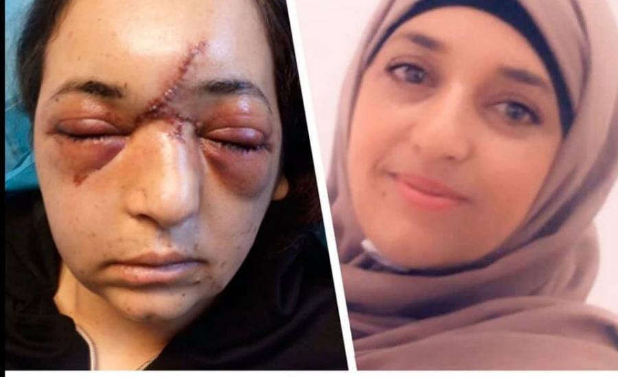 جندي اسرائيلي يكسر جمجمة سيدة فلسطينية 