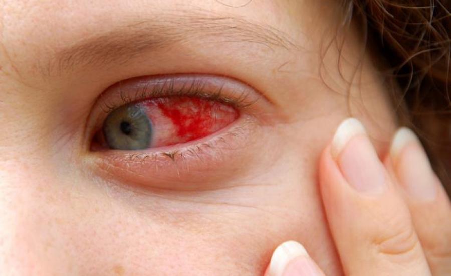 اصابة العين بالانفلونزا 