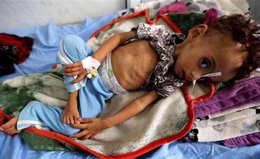 الامم المتحدة والجوع في اليمن 